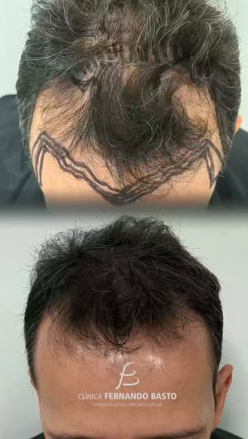 Mais do que fios, um transplante capilar pode representar o reencontro com a própria imagem e com a 