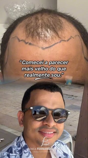 A falta de cabelo pode mudar a percepção que temos da nossa própria imagem. Neste caso, o objetivo f