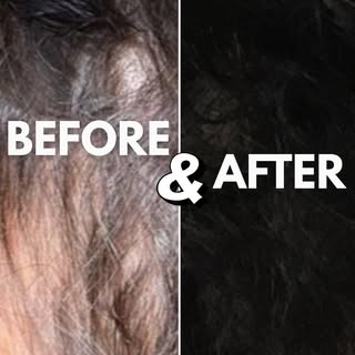 9 months. 3,006 grafts. One confident new hairline.

This is the power of the ARTAS® Robotic Hair Tr