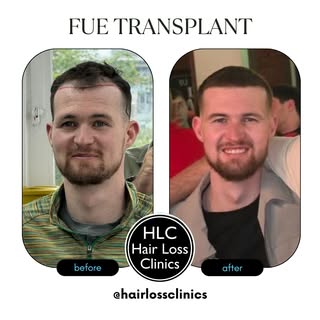 HLC Hair Transplant 💫 

• 6 Months Post Surgery
• 12 months to see optimal results
• 6 hours of sur