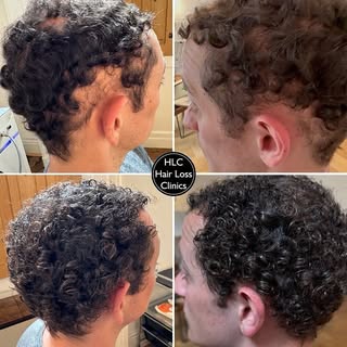 Our client had a strong form of Alopecia Areata, potentially leading to Areata Totalis if untreated.