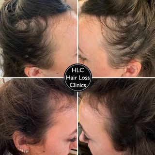 16th July ⏩ 26th November

Our client is showing great progress in their Laser Regrowth Therapy, our