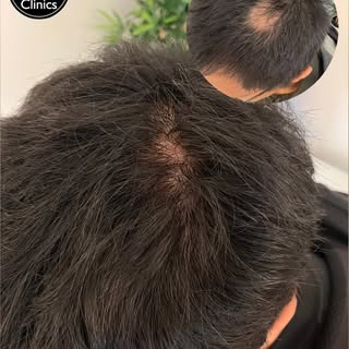 Alopecia Areata 🚮 (Swipe to See Full Photos) 

Our young client developed a patch of Alopecia Areat