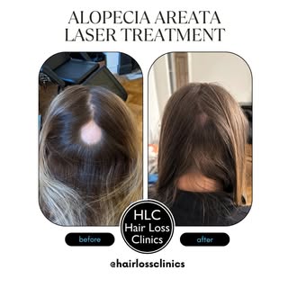 Our client got Alopecia Areata at the start of 2025, due to stress from work. After the patch contin