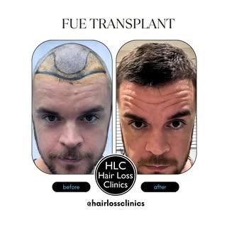 HLC Hair Transplant 💫 

• 6 Months Post Surgery
• 12 months to see optimal results
• 6 hours of sur