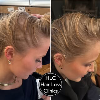 30th September ⏩ 3rd February

Our client is showing great progress in their Laser Regrowth Therapy,