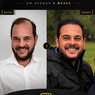 6 meses. Um novo reflexo no espelho.

Existe um momento em que a perda capilar deixa de ser apenas e