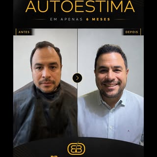Resultado de transplante capilar com 6 meses.
Apenas 6 meses separam essas duas imagens.
E a mudança