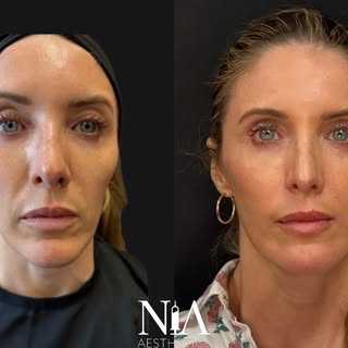 February 2025 → Now 💫

This transformation was achieved using a Hyperdilute Radiesse + HA blend pla