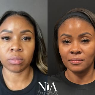 This wasn’t a quick fix. This was a full reset. 👏🏾✨

For this full face transformation, we used:
•