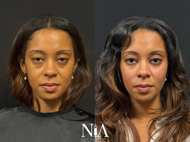The refresh you deserve 🤩✨

This beautiful result was achieved with midface restoration + undereye 