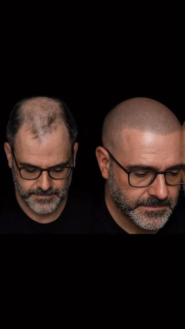 From thinning… to sharp again.

This is Scalp Micropigmentation.
The modern solution for hair loss.
