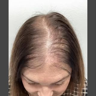 Real results in real time #alopecia #alopeciaawareness #AlopeciaAreata #hairtransformation #hairthin