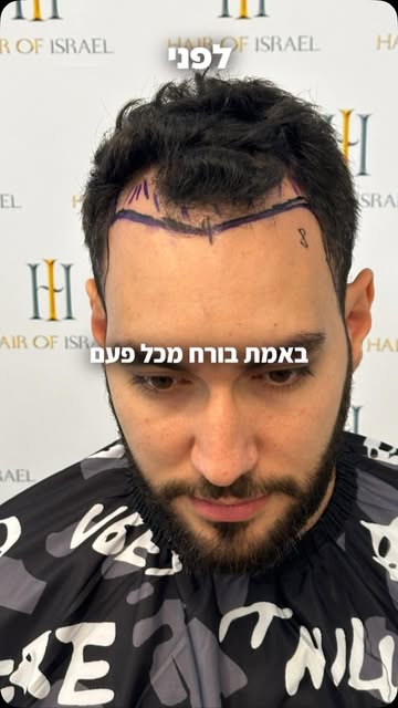 יש המלצות שמרגשות אותנו במיוחד ❤️

הוא עבר אצלנו השתלת שיער — והיא הייתה שם לצידו לאורך כל הדרך.

וה
