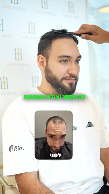 דניאל היקר, שנתיים אחרי השתלת השיער אצלנו ב־Hair of Israel ❤️

ואנחנו גאים להציג לכם את התוצאה בדיוק