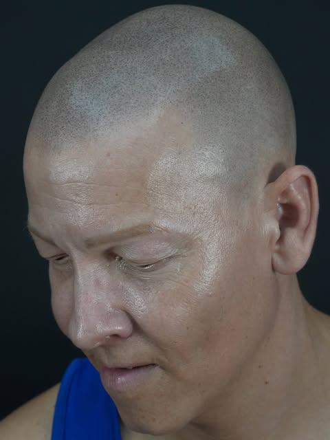 Hay heridas que nadie ve. 💔

La alopecia universal no duele físicamente, pero puede cambiar la form