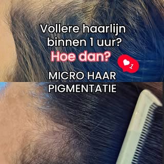 Binnen een uur al een vollere haarlijn?

Dat kan zeker!

Er zijn meerdere behandelingen nodig voor e