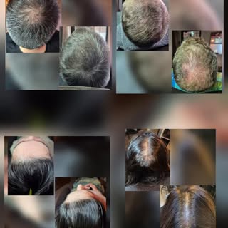Dunner wordend haar, kale plekken, of gewoon meer volume. 

Haar micropigmentatie is een permanente 