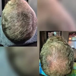 😱 Haartransplantatie gedaan, maar nog steeds doorschijnende hoofdhuid in fel licht? Dat is normaal 