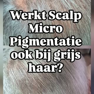 Grijs haar en SMP: het werkt, maar de aanpak is anders dan bij donker haar. Pigment kan niet lichter