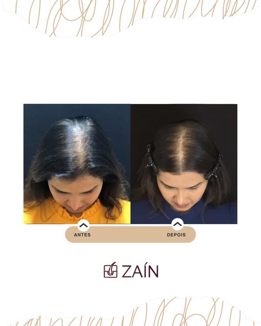 Ela chegou até a clínica incomodada com a risca central cada vez mais aparente. Ver o cabelo perdend