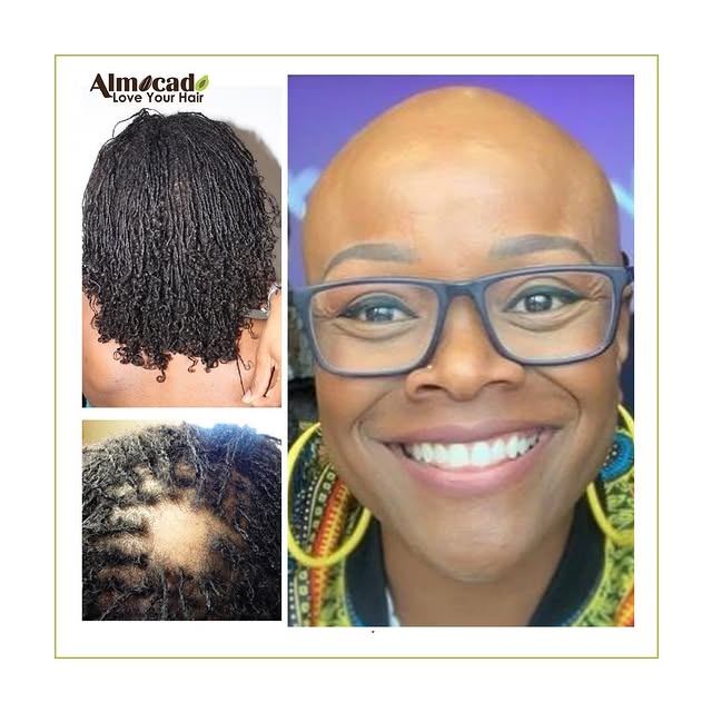 “Don’t worry, it’ll grow back.” they said. But what if it doesn’t? What if you lose all your hair ? 