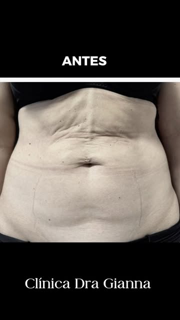 O verão está chegando e chegou a hora de mostrar o corpo que você vem construindo. 🌸

Flacidez e go