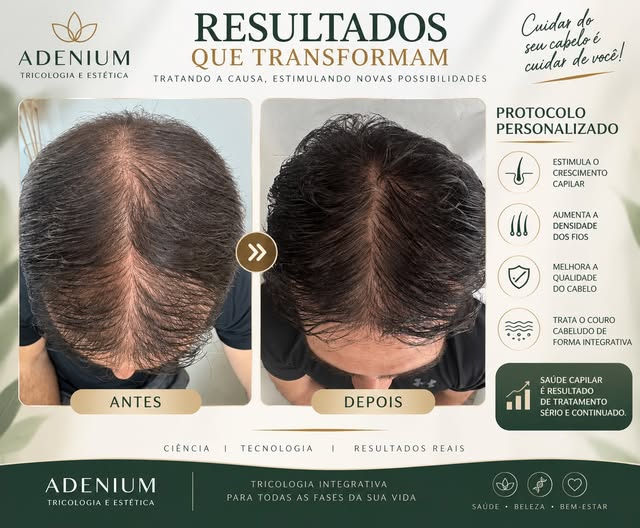 Alopecia Androgenética 

É uma condição genética e progressiva que causa o afinamento dos fios e a r