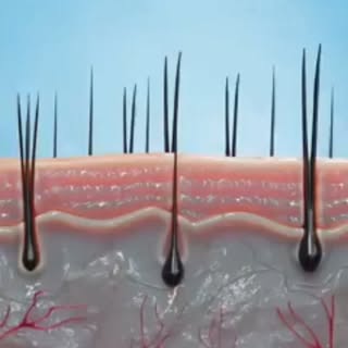 ✨ Shaving or Laser Hair Removal? Which One is Right for You? ✨

Tired of frequent shaving, razor bum