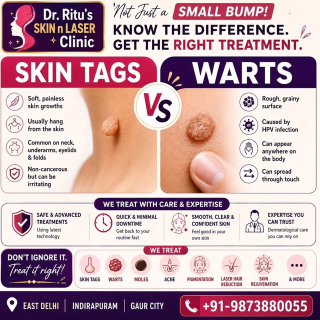 Not every skin bump is the same! 👀✨

Skin Tags vs Warts — can you tell the difference?
While skin t