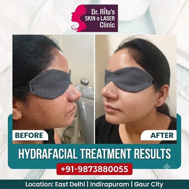 ✨ Glow. Refresh. Confidence. ✨

See the difference with our Hydrafacial Treatment 💆‍♀️✨
Healthy-loo