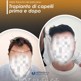 Trapianto di capelli: percorso e risultato

Ogni intervento di trapianto di capelli viene preceduto 