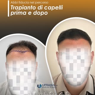 Trapianto di capelli: percorso e risultato

Ogni intervento di trapianto di capelli viene preceduto 