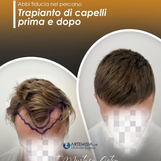 Trapianto di capelli: percorso e risultato

Ogni intervento di trapianto di capelli viene preceduto 