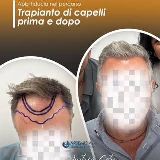 Trapianto di capelli: percorso e risultato

Ogni intervento di trapianto di capelli viene preceduto 