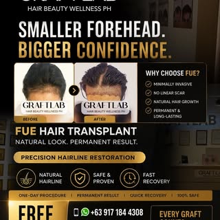 ✨ Is your forehead making you feel less confident?

A naturally balanced hairline can make a huge di