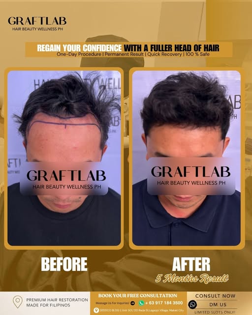 ✨ 𝟓 𝐌𝐎𝐍𝐓𝐇𝐒, 𝐀 𝐍𝐄𝐖 𝐋𝐎𝐎𝐊, 𝐀 𝐍𝐄𝐖 𝐂𝐎𝐍𝐅𝐈𝐃𝐄𝐍𝐂𝐄! ✨

From a receding hairline t