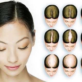 Nőknél az Alopecia Androgenetica elsősorban a fejtető homlok felőli részét érinti. Kezdete gyakran e