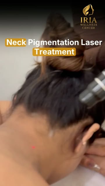 𝗡𝗲𝗰𝗸 𝗣𝗶𝗴𝗺𝗲𝗻𝘁𝗮𝘁𝗶𝗼𝗻 𝗟𝗮𝘀𝗲𝗿 𝗧𝗿𝗲𝗮𝘁𝗺𝗲𝗻𝘁 ✨

Helps reduce the appearance of pi