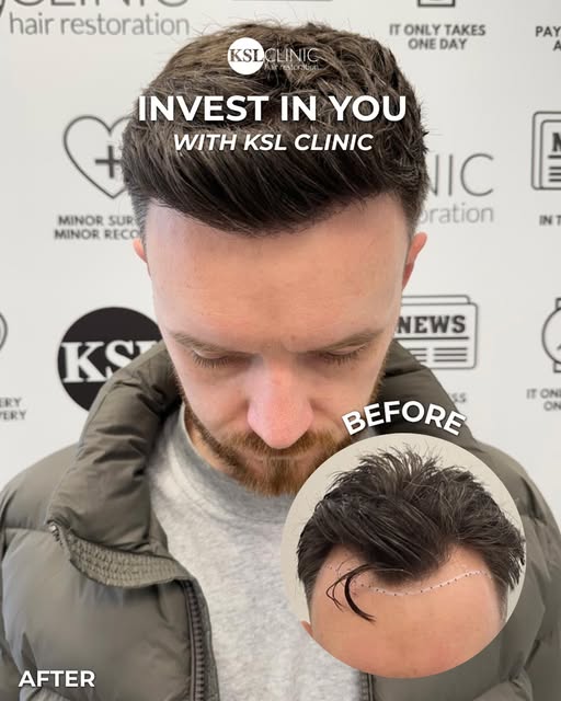 Good results take time. 🌱

A hair transplant is a journey, not an overnight transformation. From th