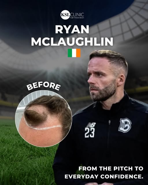 Ryan McLaughlin’s KSL hair transplant journey🇮🇪⚽️

As an Irish footballer, Ryan is a familiar face