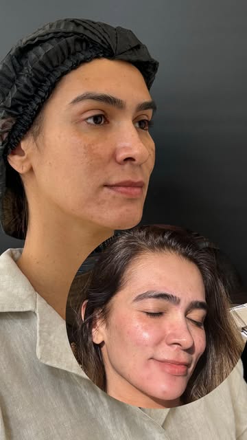 Nunca desista! TUDO tem um propósito!
Há mais de 7 anos, iniciei um quadro de MELASMA!
Não entendia 