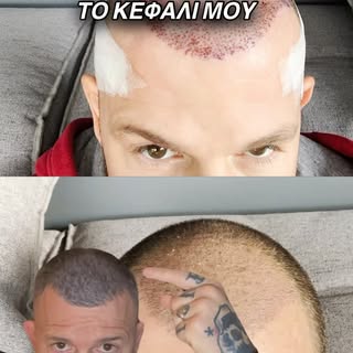 ✅Δύο φωτογραφίες. Το ίδιο κεφάλι. Το δικό μου.

Στις φωτογραφίες βλέπετε το αποτέλεσμα μετά τη μεταμ