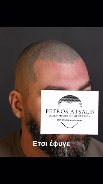 🔥Από φαλάκρα σε εικόνα ξυρισμένου κεφαλιού.
Με σωστό hairline, σωστή πυκνότητα και φυσικό αποτέλεσμ