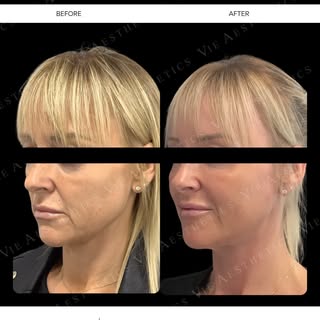 A subtle change, but a noticeable difference. ✨

This client chose Endolift to improve laxity throug