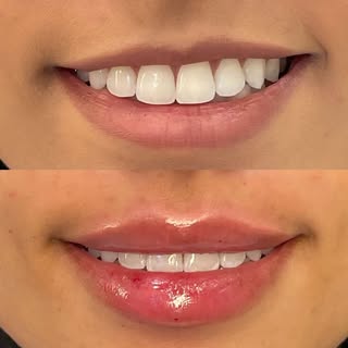 ✨ Um toque de preenchimento, um sorriso transformado! 💋 Realçar sua beleza natural é a nossa especi