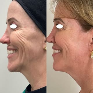 Transformação que vale a espera! ✨ 

Com bioestimuladores de colágeno, a melhora na flacidez e na qu