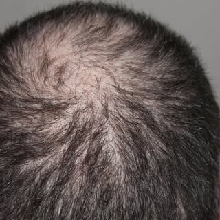 Which is the best method for a large transplant – FUE or FUT? This is a tricky question to answer. T