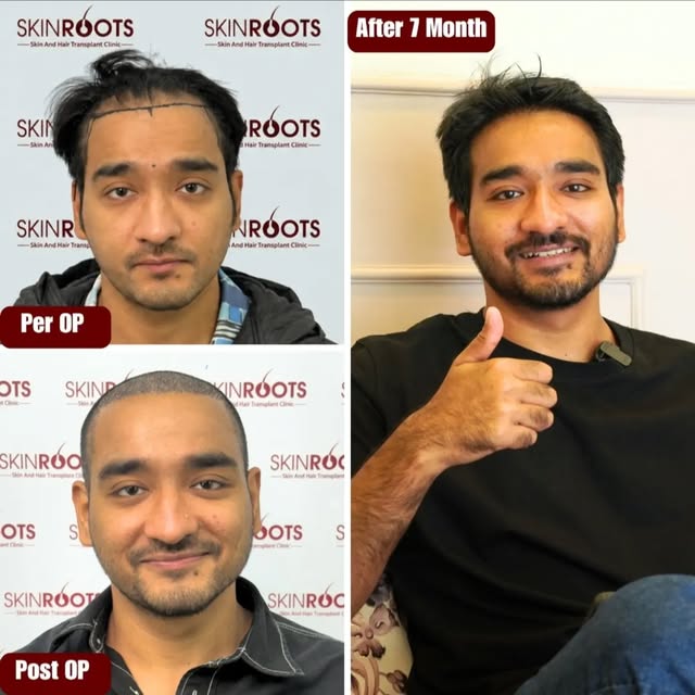 7 Months of Growth. One Powerful Transformation.

From pre-op to post-op to 7 months, this hair tran