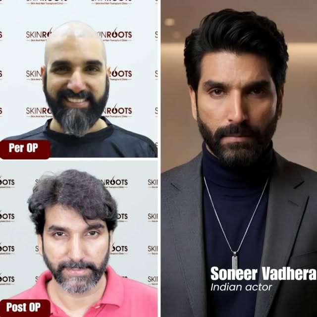 Actor Sonner Vadhera’s Hair Transplant Transformation at Skinroots Clinic

Indian actor Sonner Vadhe